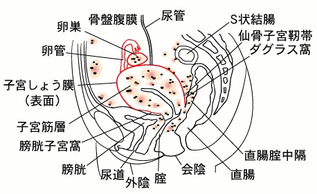 子宮内膜症が発生しやすい下腹部